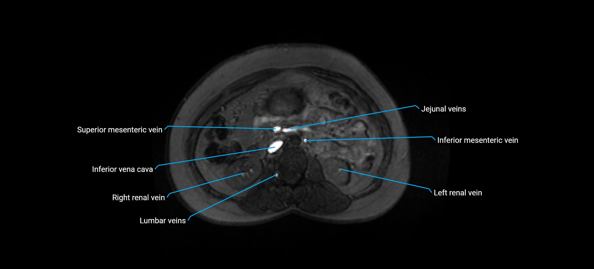 MRV abdomen pelvis & lower limb axial cross sectional anatomy labelled MRI image 77 (1).webp